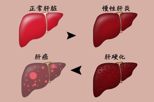 开云 开云体育77岁院士呼吁:停止饮用1“茶叶”或比烟酒还伤肝建议早处理(图2) 开云 开云体育77岁院士呼吁:停止饮用1“茶叶”或比烟酒还伤肝建议早处理(图2)